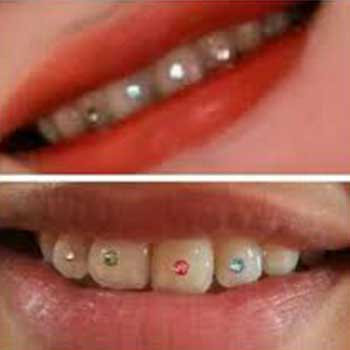 ahli gigi  bali  Diamond  Teeth Permata Gigi  fashion 